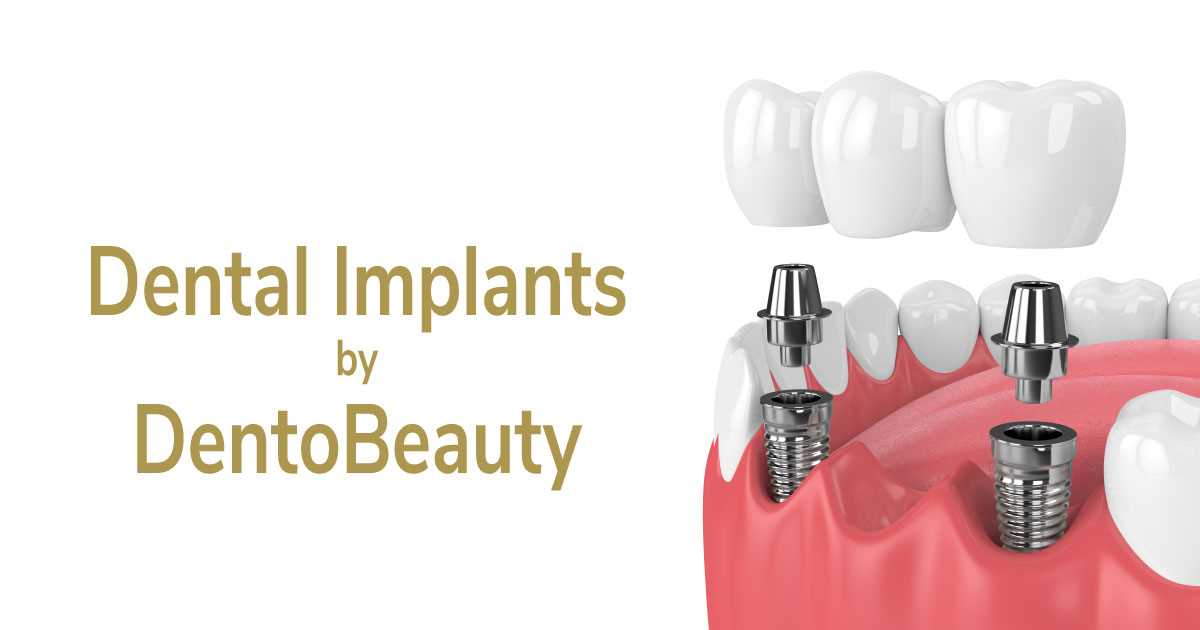Dental Implants Available at DentoBeauty Grays, Essex